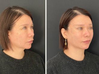 Fili riassorbibili prima e dopo - 877289