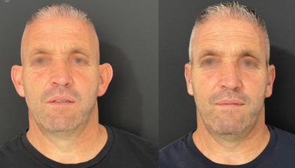 Dr. Roberto Loche Otoplastica