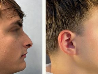 Rinoplastica prima e dopo - 877292