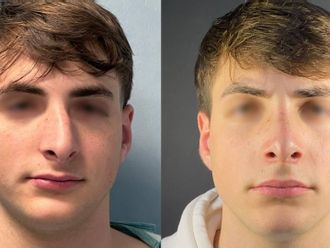 Rinoplastica prima e dopo - 877294