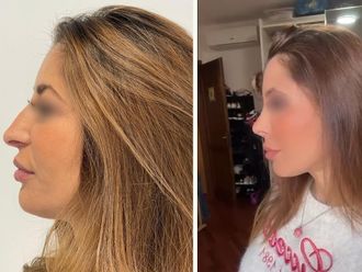 Rinoplastica prima e dopo - 877295