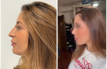 Dr. Roberto Loche Rinoplastica