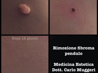 Fibroma pendulo prima e dopo