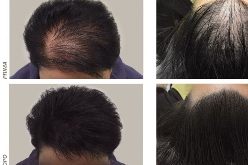 Alopecia prima e dopo - 762620