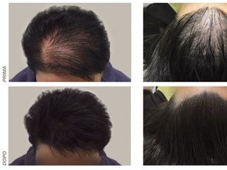 alopecia androgenetica prima e dopo