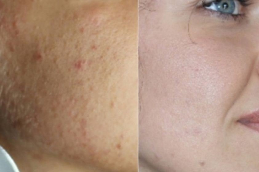Acne prima e dopo - 766401