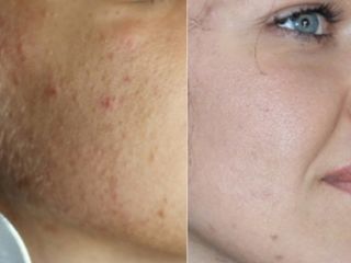 Pre e Post Peeling