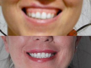 Studio Medico Ametìs Dott.ssa Elena Vescovi Gummy Smile prima e dopo