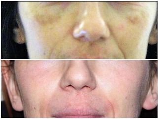 Melasma prima e dopo
