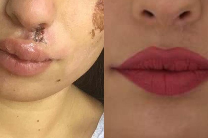 Rimozione tatuaggi prima e dopo - 766657
