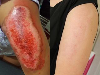 Cicatrice post traumatica prima e dopo