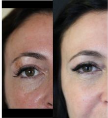 macchie prima e dopo