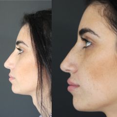 Filler labiale prima e dopo