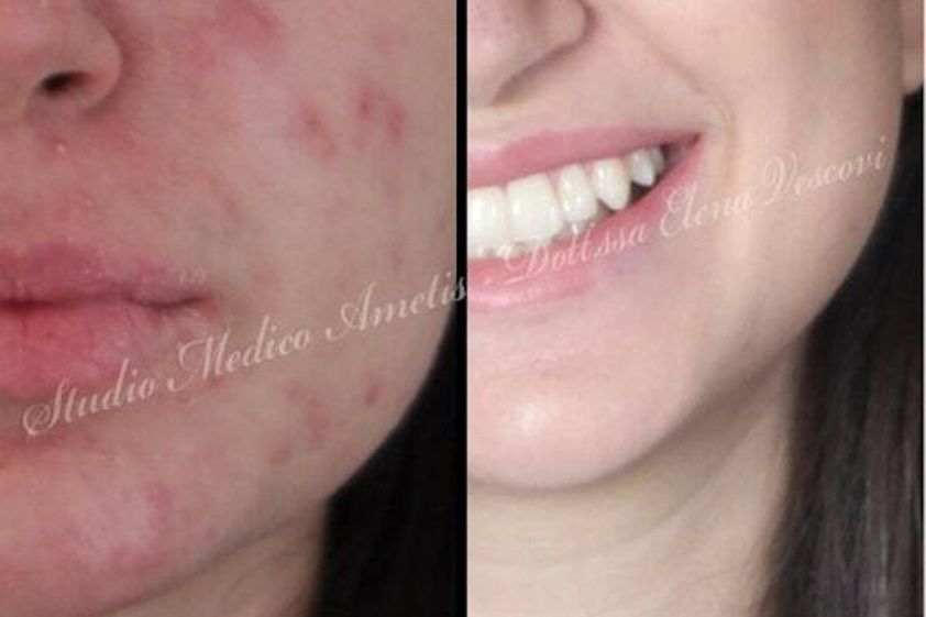 Acne prima e dopo - 772844