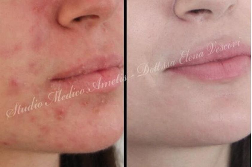 Acne prima e dopo - 772846