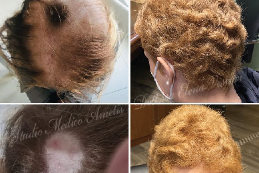 Alopecia prima e dopo - 785548