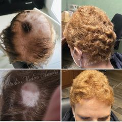 Alopecia - Studio Medico Ametìs Dott.ssa Elena Vescovi