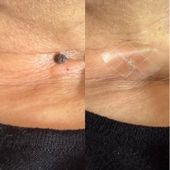 Studio Medico Ametìs Dott.ssa Elena Vescovi Rimozione nevo