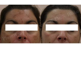 melasma prima dopo