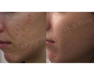 Needling e Dermastamp prima dopo