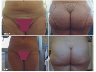 liposuzione prima dopo