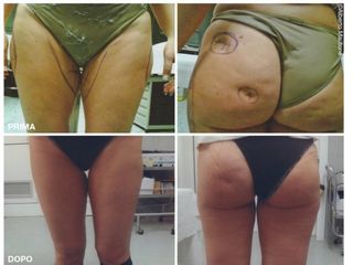 liposuzione prima dopo