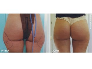 liposuzione prima dopo