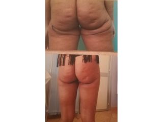 liposuzione prima dopo