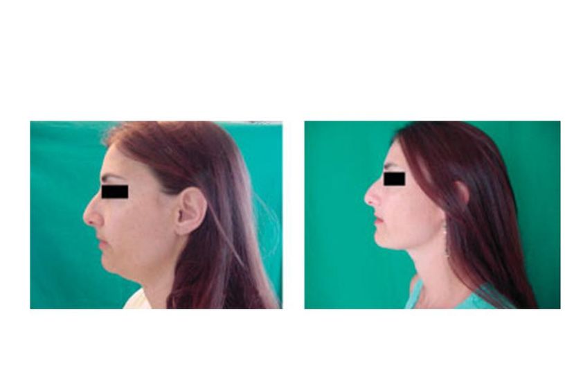 Laserlipolisi prima e dopo - 747922