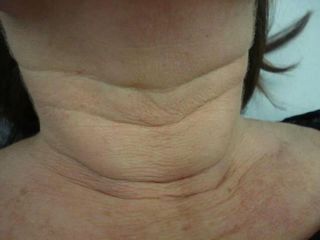 Fili di biostimolazione prima