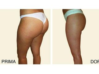 Laserlipolisi prima e dopo