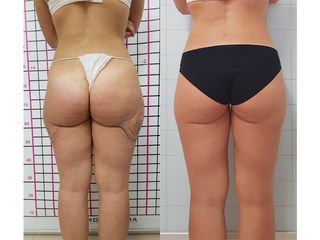 Vaserlipo prima e dopo