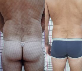 Liposcultura con sistema vaser - Dott. Giovanni Profeta