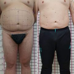 Liposuzione - Dott. Giovanni Profeta