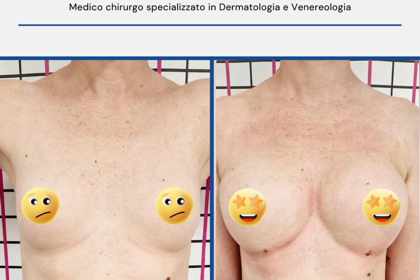 Lipofilling prima e dopo - 850341