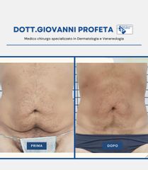 Liposuzione - Dott. Giovanni Profeta