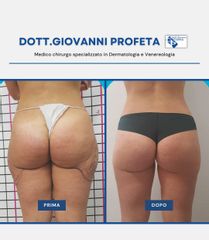 Liposuzione - Dott. Giovanni Profeta