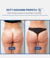 Cellulite - Dott. Giovanni Profeta