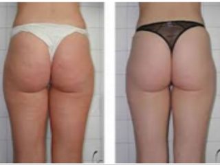 Cellulite prima dopo