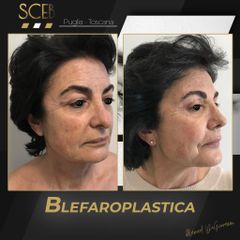 Blefaroplastica - SCEB Salute Chirurgia Estetica Benessere - Dott. Manuel De Giovanni