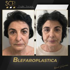 Blefaroplastica - SCEB Salute Chirurgia Estetica Benessere - Dott. Manuel De Giovanni