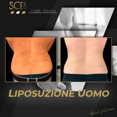 Liposuzione  - SCEB Salute Chirurgia Estetica Benessere - Dott. Manuel De Giovanni