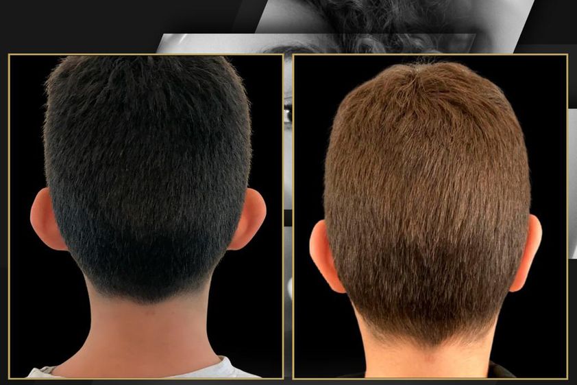 Otoplastica prima e dopo - 831597