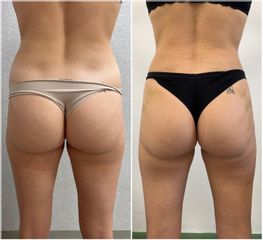Liposuzione  - SCEB Salute Chirurgia Estetica Benessere - Dott. Manuel De Giovanni