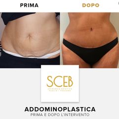 SCEB Salute Chirurgia Estetica Benessere Addominoplastica