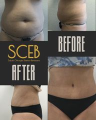 SCEB Salute Chirurgia Estetica Benessere Lipoaddominolpastica