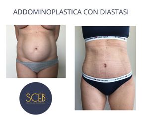 SCEB Salute Chirurgia Estetica Benessere Addominoplastica con diastasi