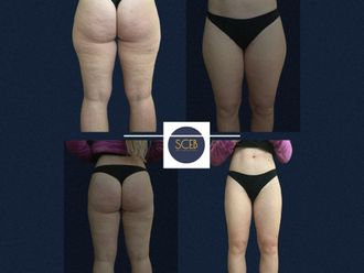 Liposuzione prima e dopo - 880371