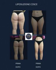 SCEB Salute Chirurgia Estetica Benessere Liposuzione cosce