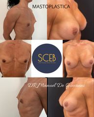 SCEB Salute Chirurgia Estetica Benessere Mastoplastica additiva